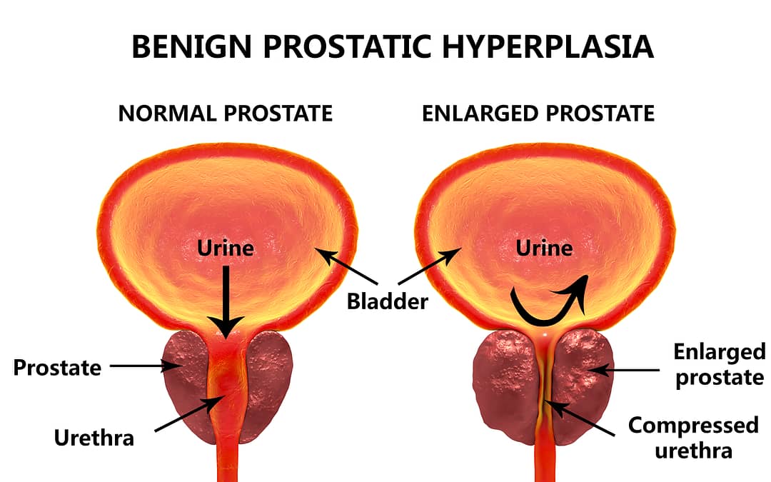 Prostate Health: Understanding Benign Prostatic Hyperplasia (BPH) – Causes, Symptoms, and Effective Management