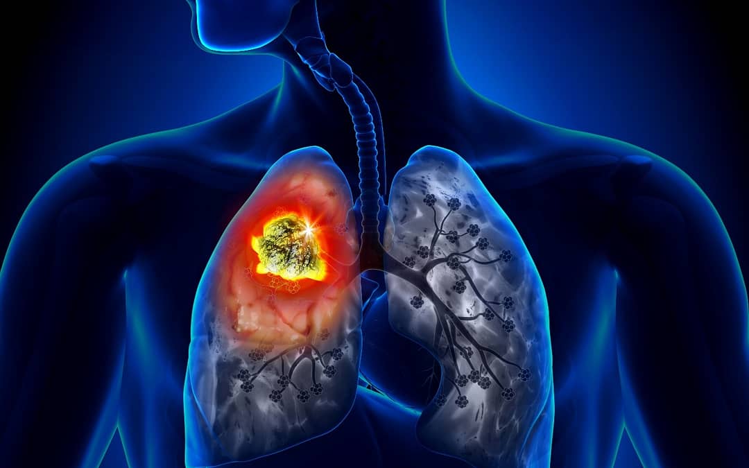 Survival Rates and Risk Factors of Lung Cancer in Men