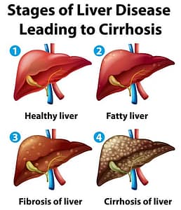 Stages of Liver Disease